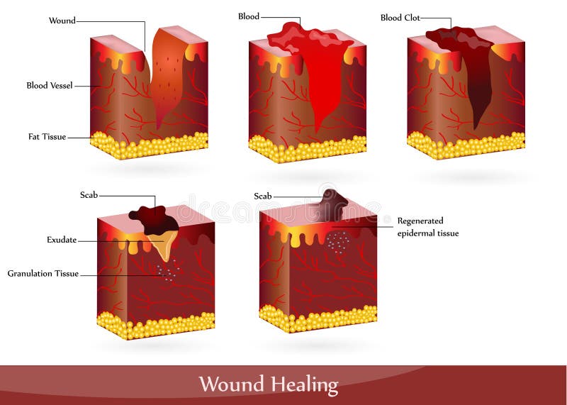 The process of wound healing. Illustration showing skin after injury, appears blood, then blood clot, then scab. The process of wound healing. Illustration showing skin after injury, appears blood, then blood clot, then scab.