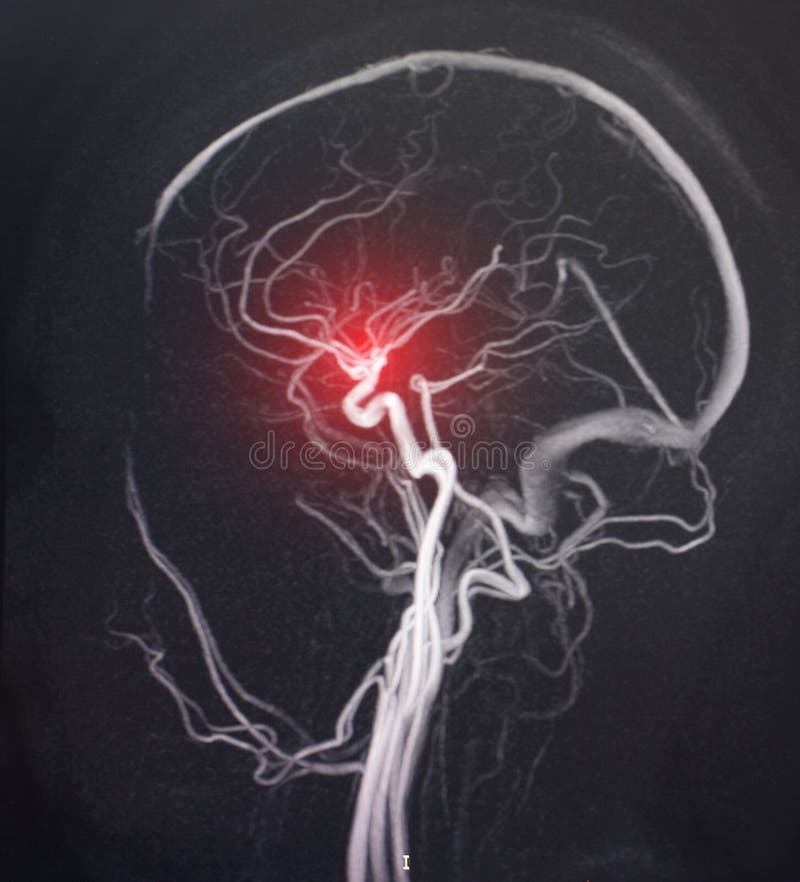 MRI image of a brain vessel. The concept of cerebrovascular disease, stroke and circulatory disorders, atherosclerosis, hypertonic disease. MRI image of a brain vessel. The concept of cerebrovascular disease, stroke and circulatory disorders, atherosclerosis, hypertonic disease