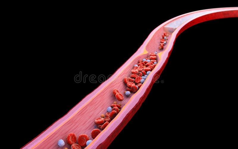 Cross-section vein, artery, Atherosclerosis illustration. High cholesterol. Blood clot, red blood cells, white blood cells, medical style leading to illness, plasma, 3D model. Cross-section vein, artery, Atherosclerosis illustration. High cholesterol. Blood clot, red blood cells, white blood cells, medical style leading to illness, plasma, 3D model