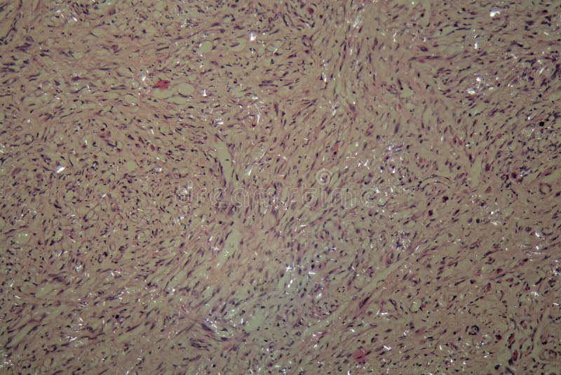 Рак яичек стоковое фото. изображение насчитывающей пенис - 125393396