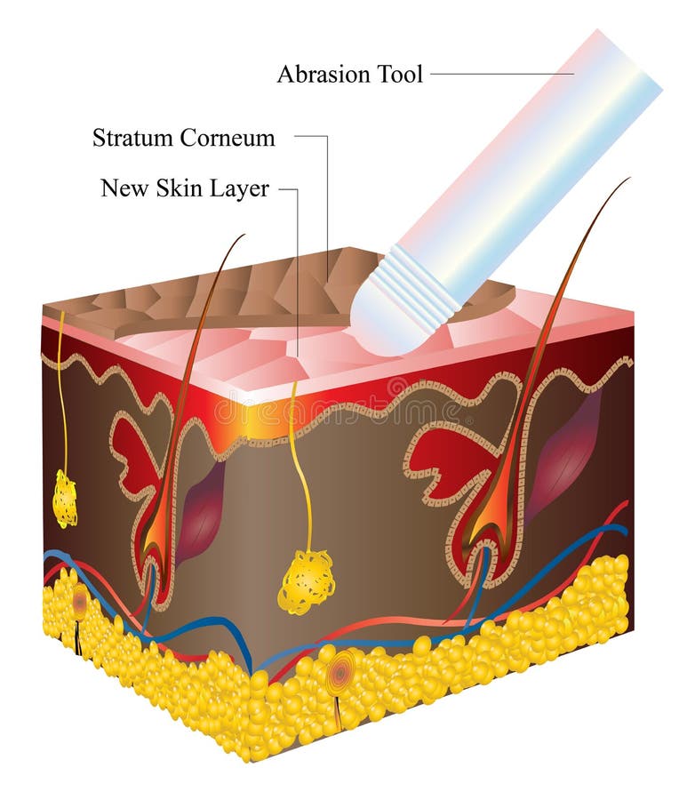 Skin abrasion illustration. After this procedure there is a new healthy skin layer. Skin abrasion illustration. After this procedure there is a new healthy skin layer.