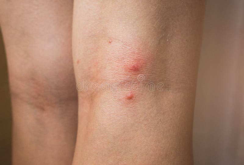 Дирофиляриоз: какие последствия может иметь укус комара