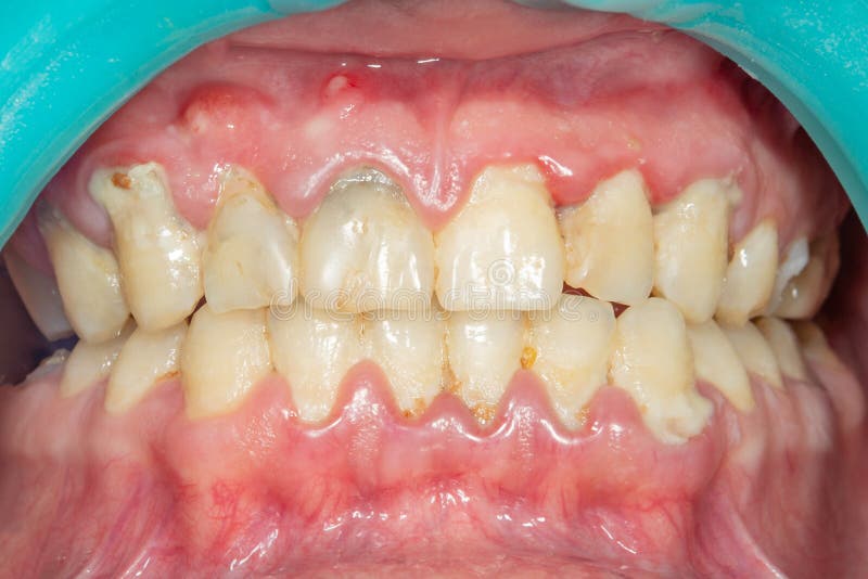 Close-up of a person`s teeth after removing and cleaning a plaque in a dental clinic. Healthy smile concept. Close-up of a person`s teeth after removing and cleaning a plaque in a dental clinic. Healthy smile concept