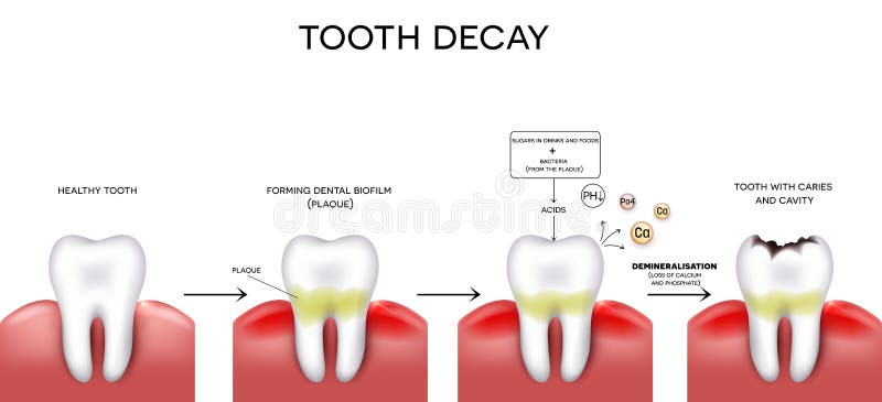 Tooth decay formation step by step, healthy tooth, forming dental plaque and finally caries and cavity. Tooth decay formation step by step, healthy tooth, forming dental plaque and finally caries and cavity