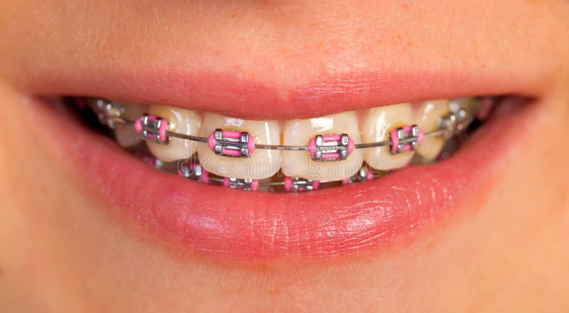 Extremely close up of a pink dental braces. Extremely close up of a pink dental braces