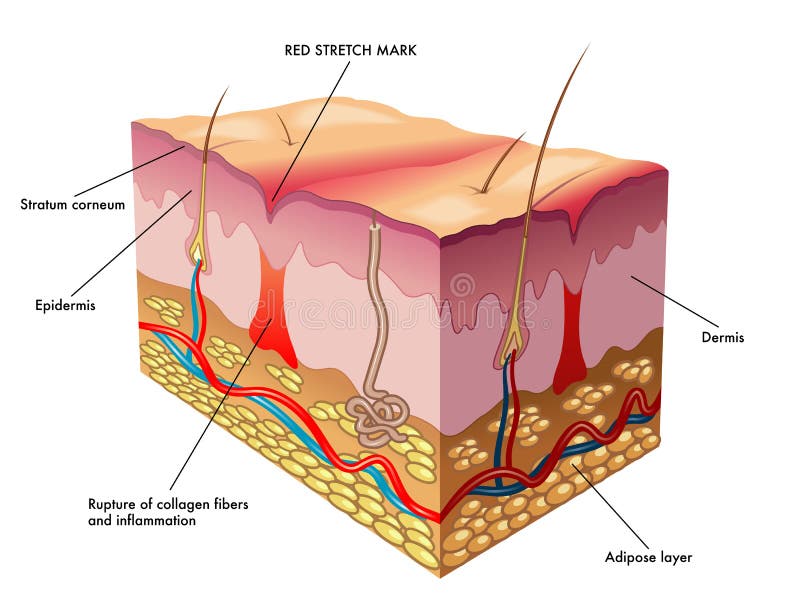 Medical illustration of the process of formation of red stretch marks. Medical illustration of the process of formation of red stretch marks