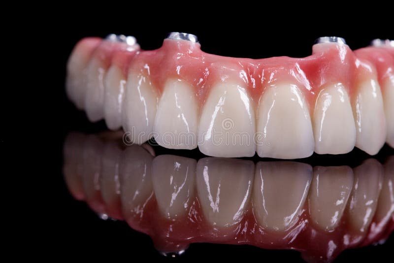 Beautiful upper teeth ceramic press ceramic crowns and veneers on the dental stone model zircon arch ceramic prothesis Implants . Dental restoration treatment clinic patient. oral surgery dentist. Beautiful upper teeth ceramic press ceramic crowns and veneers on the dental stone model zircon arch ceramic prothesis Implants . Dental restoration treatment clinic patient. oral surgery dentist