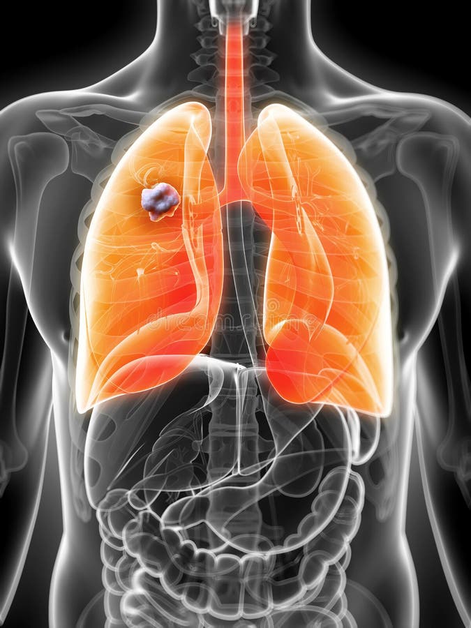 3d rendered illustration of the male lung - cancer. 3d rendered illustration of the male lung - cancer