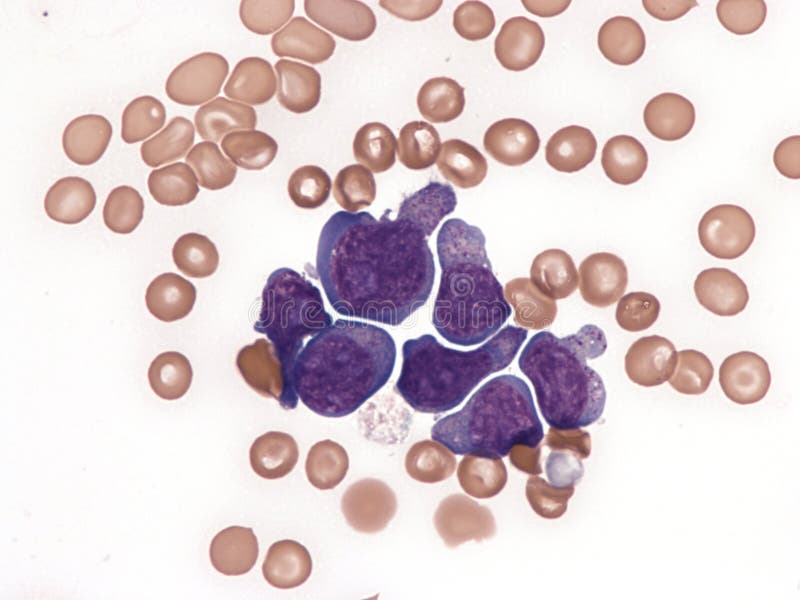 лимфома. цитология костного мозга. Стоковое Изображение - изображение ...