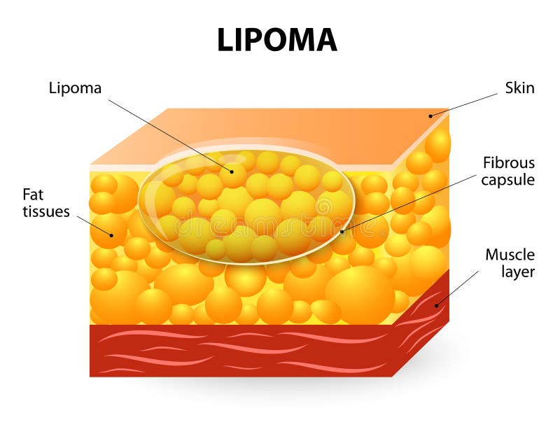 Lipoma are adipose tumors located in the subcutaneous tissues. Lipoma are adipose tumors located in the subcutaneous tissues.