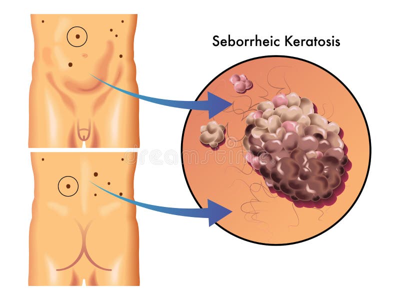Medical illustration of the symptoms of seborrheic keratosis