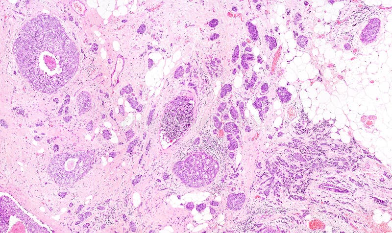 Photomicrograph of a ductal adenocarcinoma of the breast. Photomicrograph of a ductal adenocarcinoma of the breast