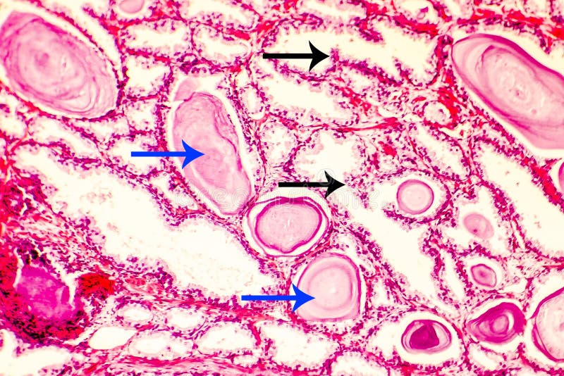 Микроснимок гиперплазии простаты Стоковое Фото - изображение ...