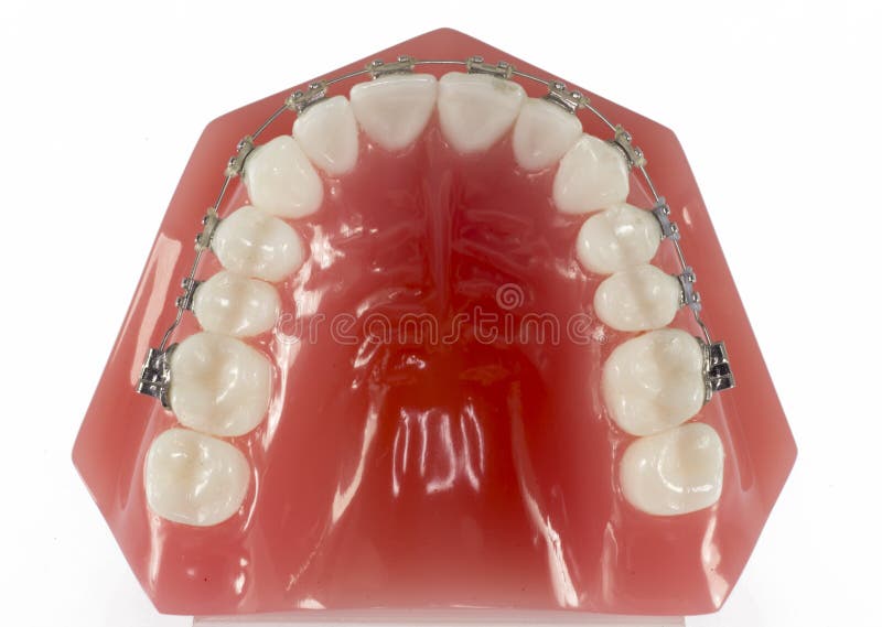 Model of teeth in orthodontic treatment view from the occlusal. Model of teeth in orthodontic treatment view from the occlusal