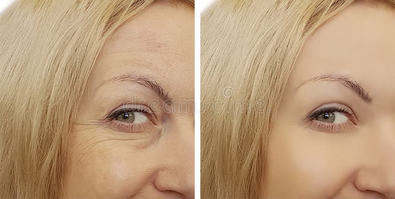 Морщинки стороны женщины before and after стоковая фотография rf Морщинки стороны женщины before and after стоковая фотография rf