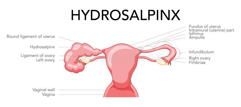 Ovarios inflamados menopausia