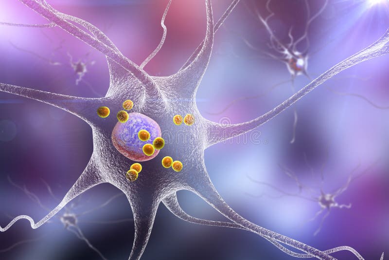 Нейроны в Parkinson& x27; заболевание s иллюстрация вектора Нейроны в Parkinson& x27; заболевание s иллюстрация вектора