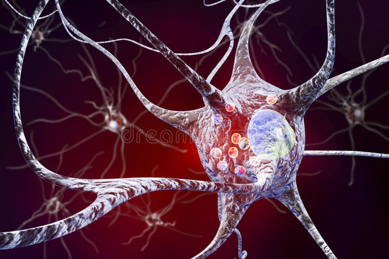 Нейроны в Parkinson& x27; заболевание s бесплатная иллюстрация Нейроны в Parkinson& x27; заболевание s бесплатная иллюстрация