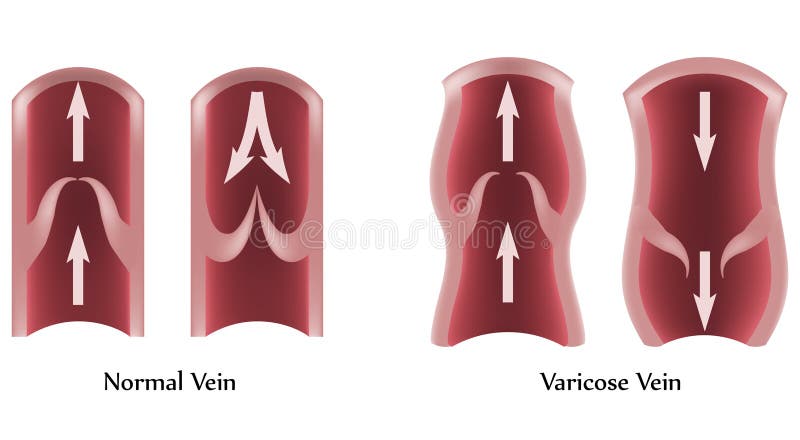 Illustration showing Varicose Veins and normal veins. Isolated white background. Illustration showing Varicose Veins and normal veins. Isolated white background.