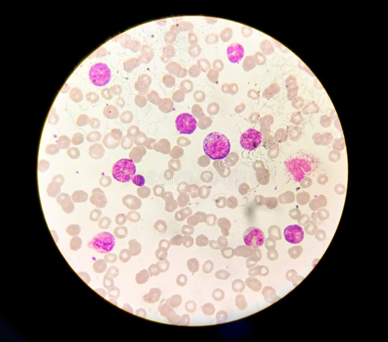 острая миелоидная лейкемия амл - это вид рака крови. Стоковое Фото ...
