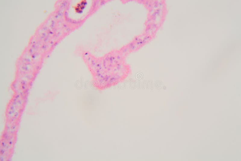 parazita schistosomiasis
