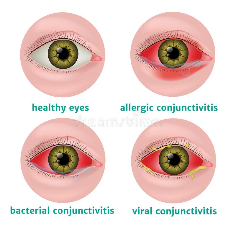 Conjunctivitis. Diseases of the Human Eye Stock Illustration