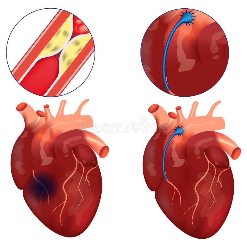 Coronary Bypass. Surgery To Restore Blood Flow in the Arteries of the