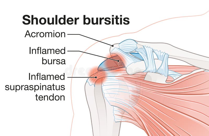 torn bursa shoulder az ízületek és az izmok fájnak a csontokról