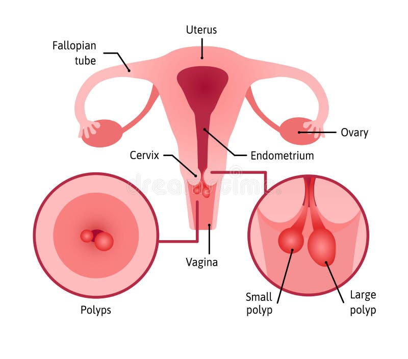 polip endometrium rák
