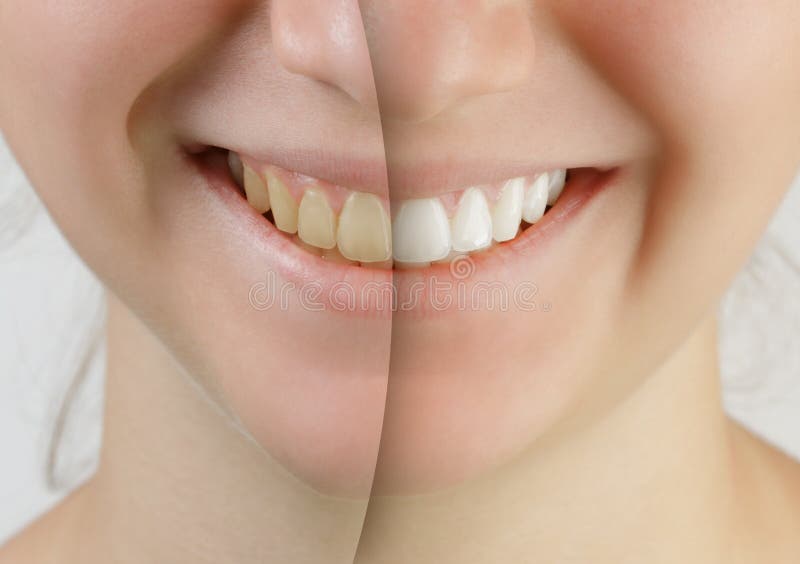 Teen girl smile before and after teeth whitening, close up. Teen girl smile before and after teeth whitening, close up