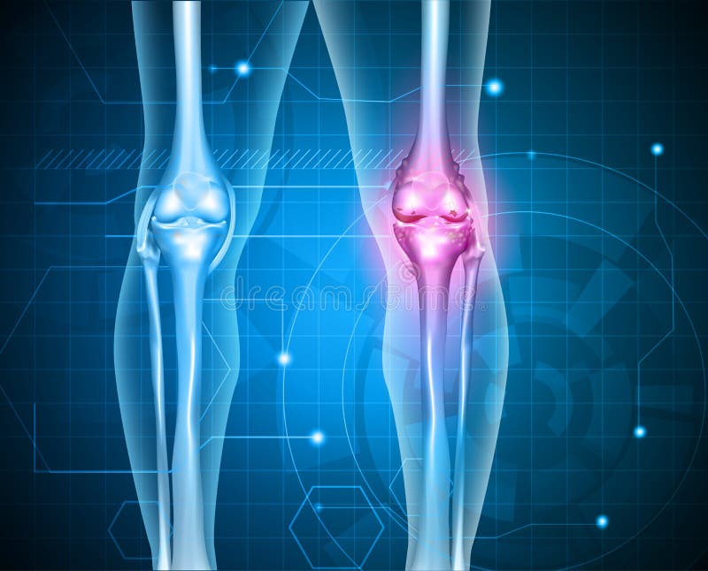 Knee pain abstract background. Healthy joint and unhealthy painful joint with osteoarthritis. Knee pain abstract background. Healthy joint and unhealthy painful joint with osteoarthritis.