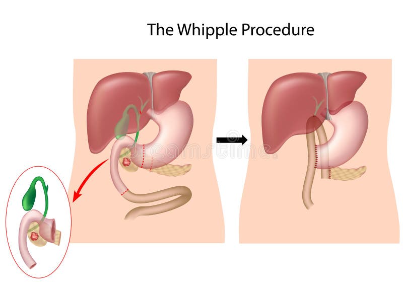 Процедура по Whipple иллюстрация вектора Процедура по Whipple иллюстрация вектора
