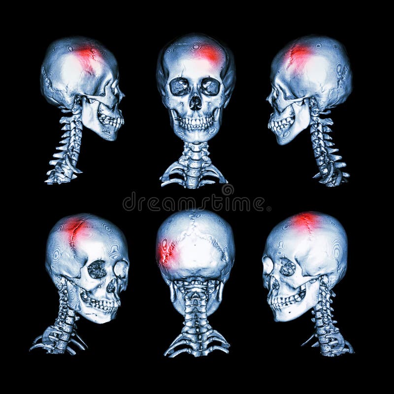 Развертка CT и изображение 3D головного и цервикального позвоночника Используйте это изображение для хода, трещиноватости черепа, иллюстрация вектора Развертка CT и изображение 3D головного и цервикального позвоночника Используйте это изображение для хода, трещиноватости черепа, иллюстрация вектора