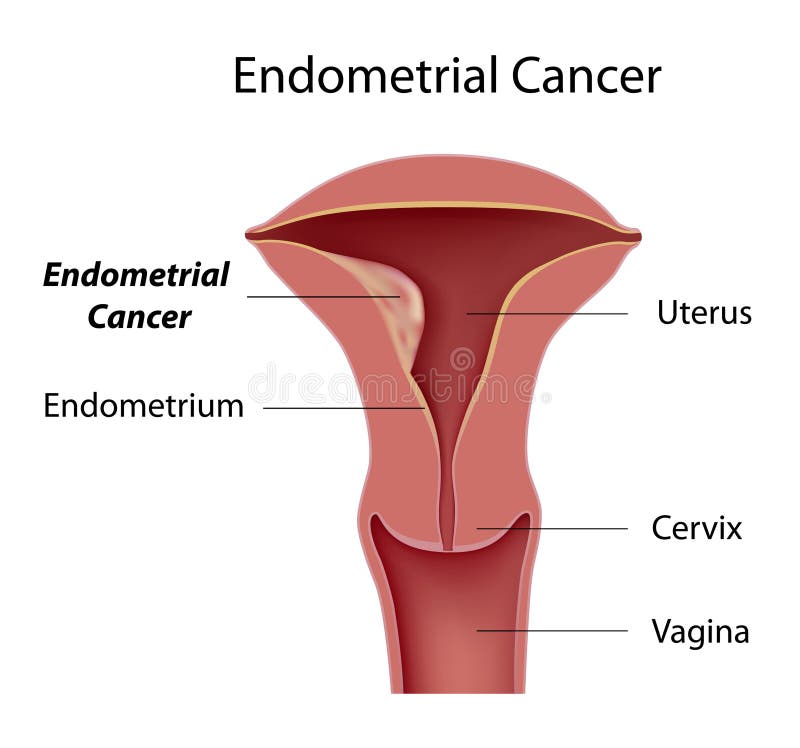 endometrium rák ct)