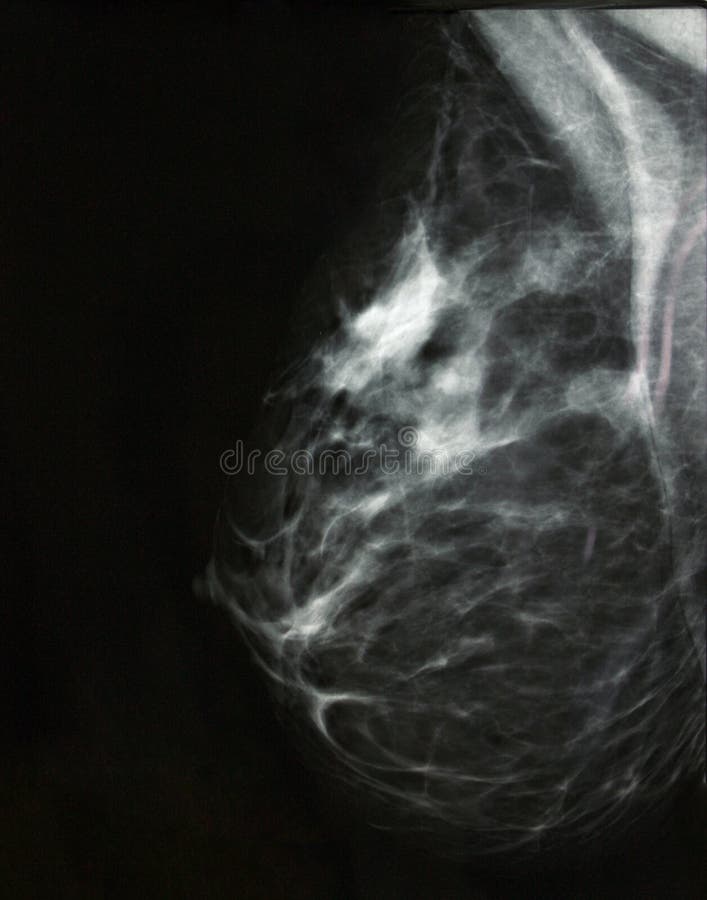 Digital mammography image, screening for breast cancer, radiology. Digital mammography image, screening for breast cancer, radiology