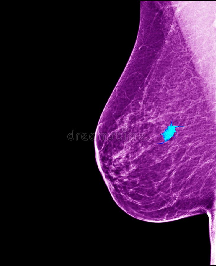 Digital mammography image breast, screening for breast cancer, radiology. Digital mammography image breast, screening for breast cancer, radiology