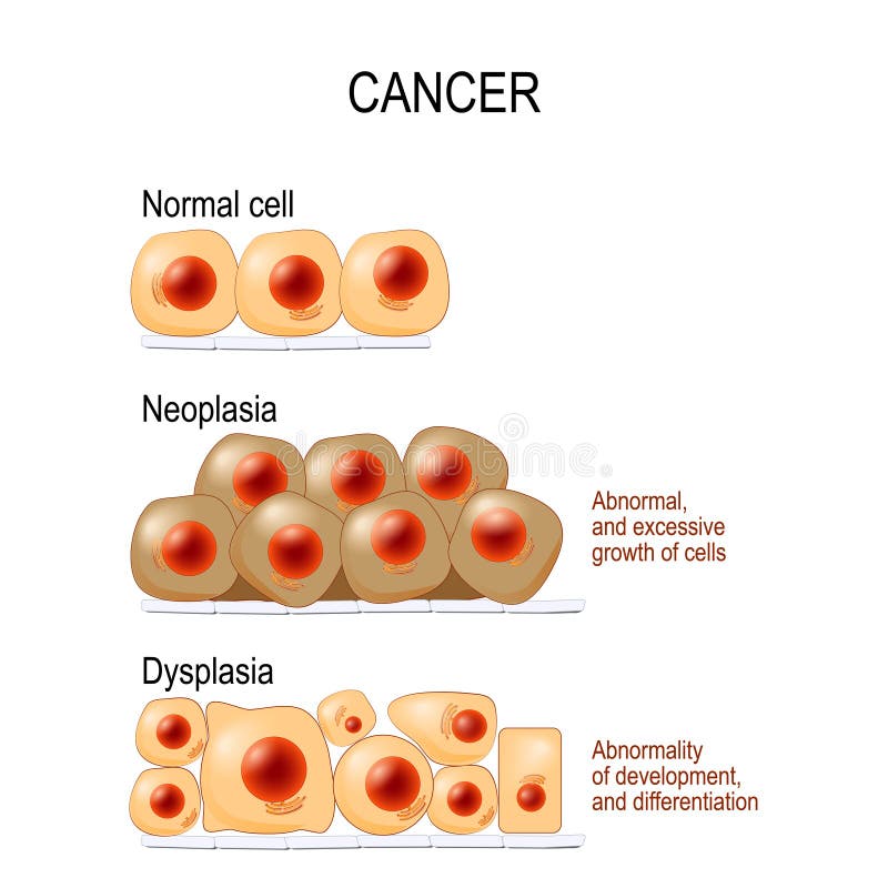 Normal cells, Dysplasia abnormality of development, and differentiation, and Neoplasia Abnormal, and excessive growth of cells. different. Vector diagram for educational, medical, biological and science use. Normal cells, Dysplasia abnormality of development, and differentiation, and Neoplasia Abnormal, and excessive growth of cells. different. Vector diagram for educational, medical, biological and science use