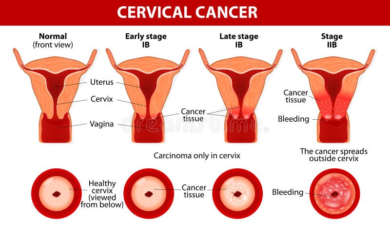 Miért okozhat rákot a HPV? Különböző testrészeken alakulhat ki a daganat - Egészség | Femina