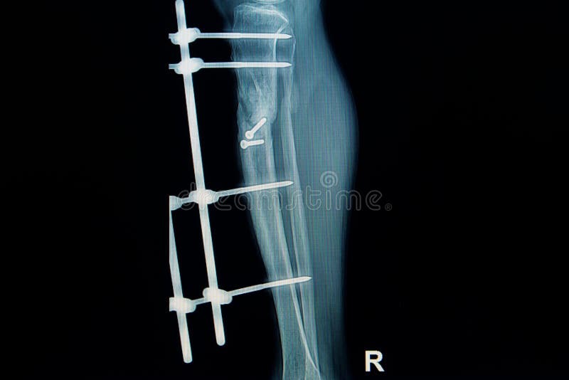 Рентгенизируйте изображение ноги трещиноватости (берца) с implant стоковое фото Рентгенизируйте изображение ноги трещиноватости (берца) с implant стоковое фото