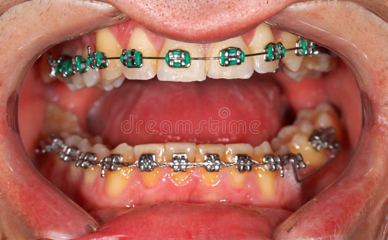 Picture of a dental brace examination at a clinic. Picture of a dental brace examination at a clinic