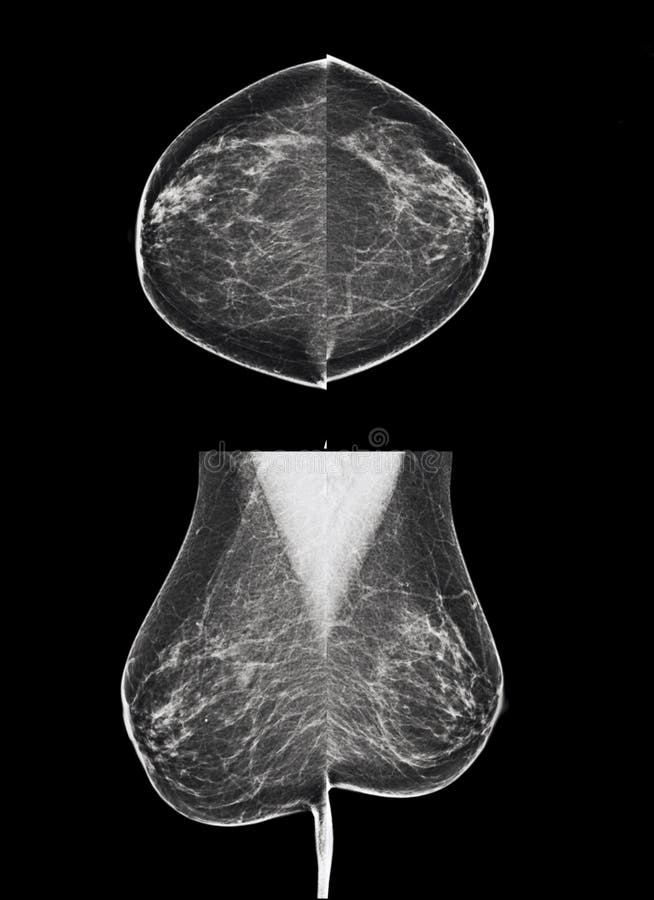 Digital mammography image of both breasts, screening for breast cancer, radiology. Digital mammography image of both breasts, screening for breast cancer, radiology