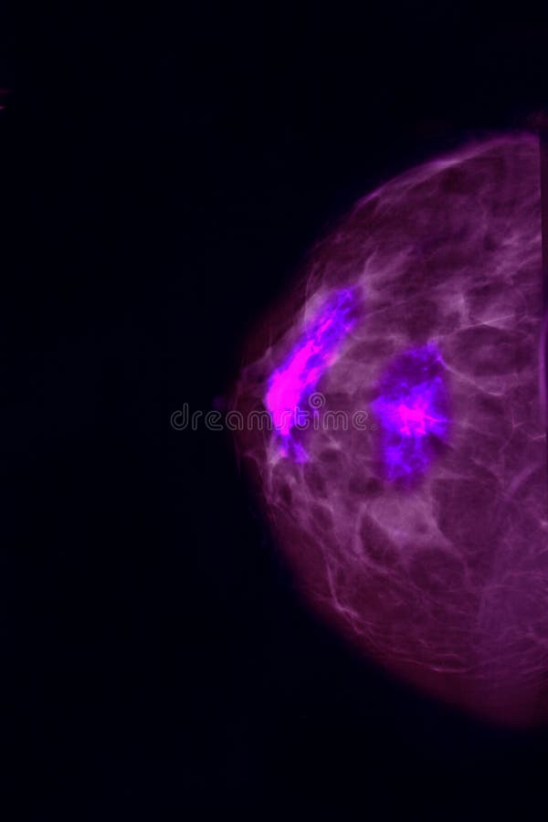 Digital mammography image, screening for breast cancer, radiology. Digital mammography image, screening for breast cancer, radiology