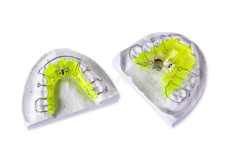 Removable orthodontic appliance with plaster cast. Removable orthodontic appliance with plaster cast.