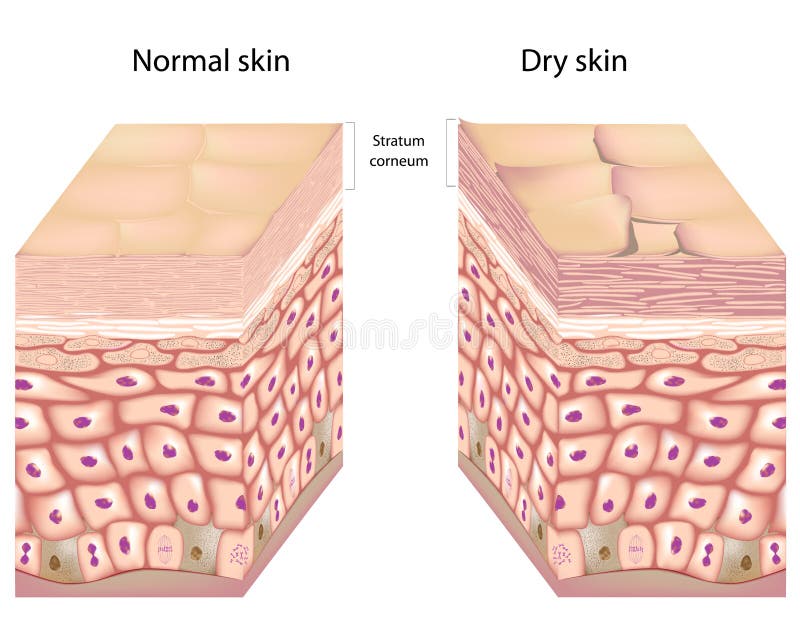 Anatomy of human epidermis with stratum corneum flaking off in dry skin. Anatomy of human epidermis with stratum corneum flaking off in dry skin