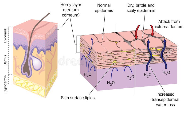 Section through skin showing normal epidermis and skin surface structure resulting in water loss and dry, brittle, scaly skin. Created in Adobe Illustrator. EPS 10. Section through skin showing normal epidermis and skin surface structure resulting in water loss and dry, brittle, scaly skin. Created in Adobe Illustrator. EPS 10.