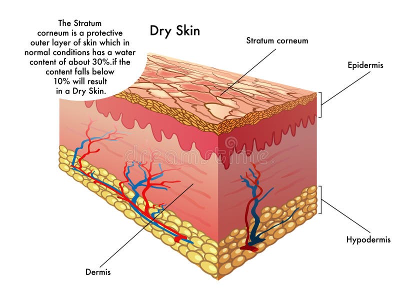 Medical illustration of the effects of dry skin. Medical illustration of the effects of dry skin