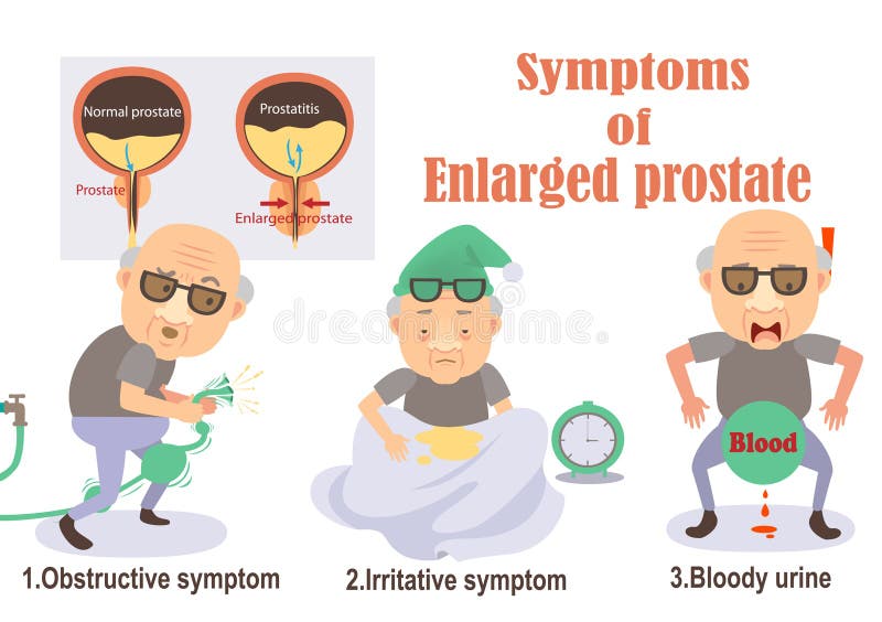 Увеличенная простата иллюстрация вектора. иллюстрации насчитывающей ...