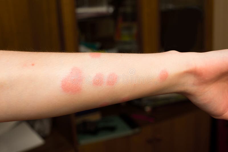 Укусы блохи на человеке стоковое фото. изображение насчитывающей ...