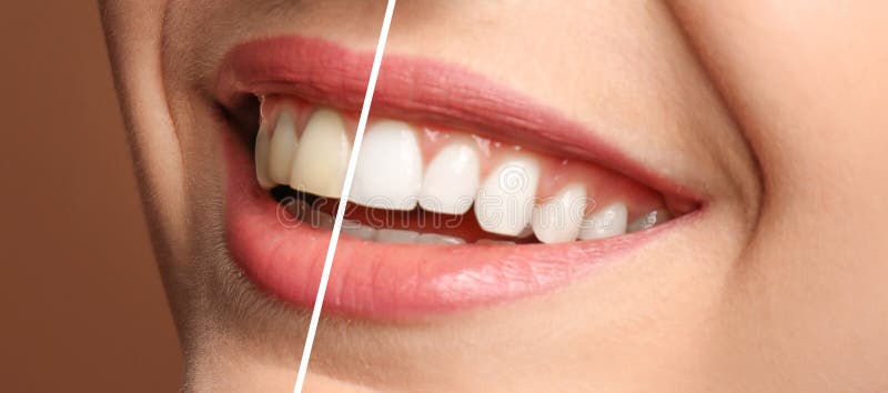 Smiling woman before and after teeth whitening procedure, closeup. Smiling woman before and after teeth whitening procedure, closeup