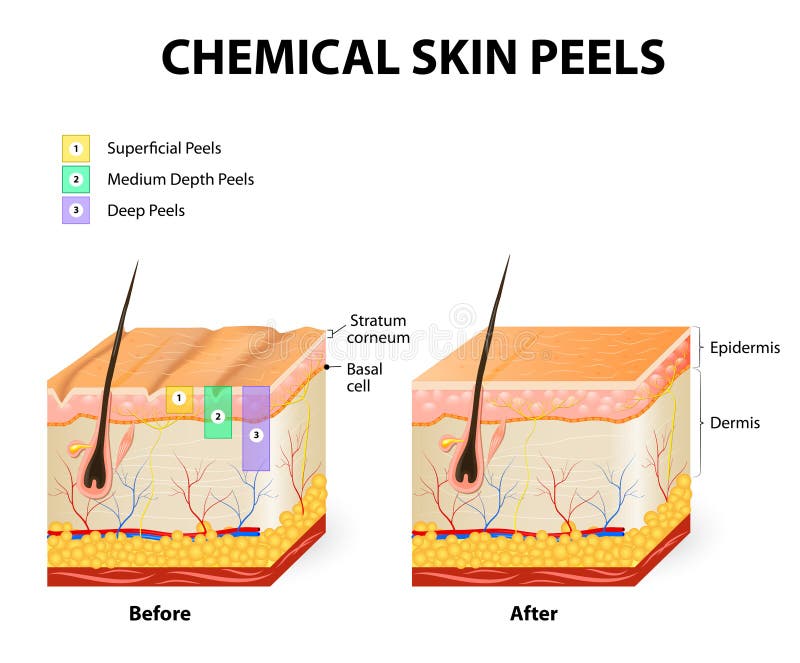 Chemical peeling or procedure chemexfoliation. Human skin layers. Chemical peeling or procedure chemexfoliation. Human skin layers